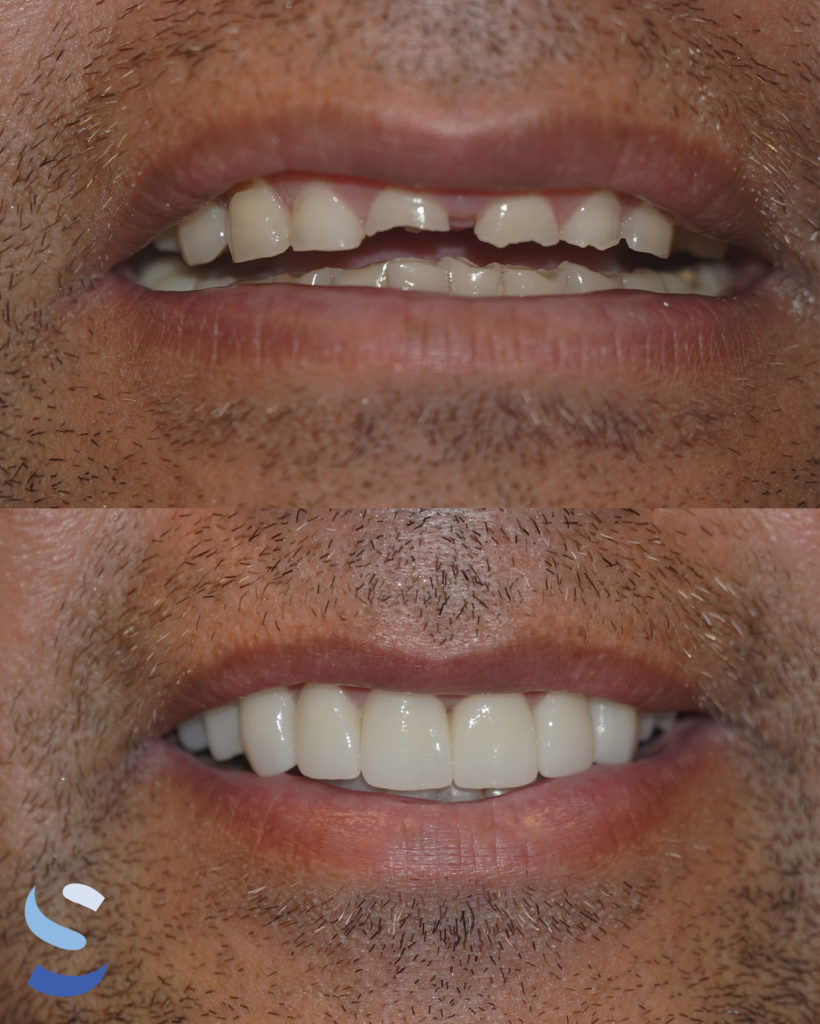 Before After Image