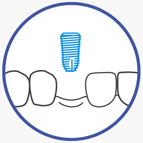 DENTAL IMPLANTS