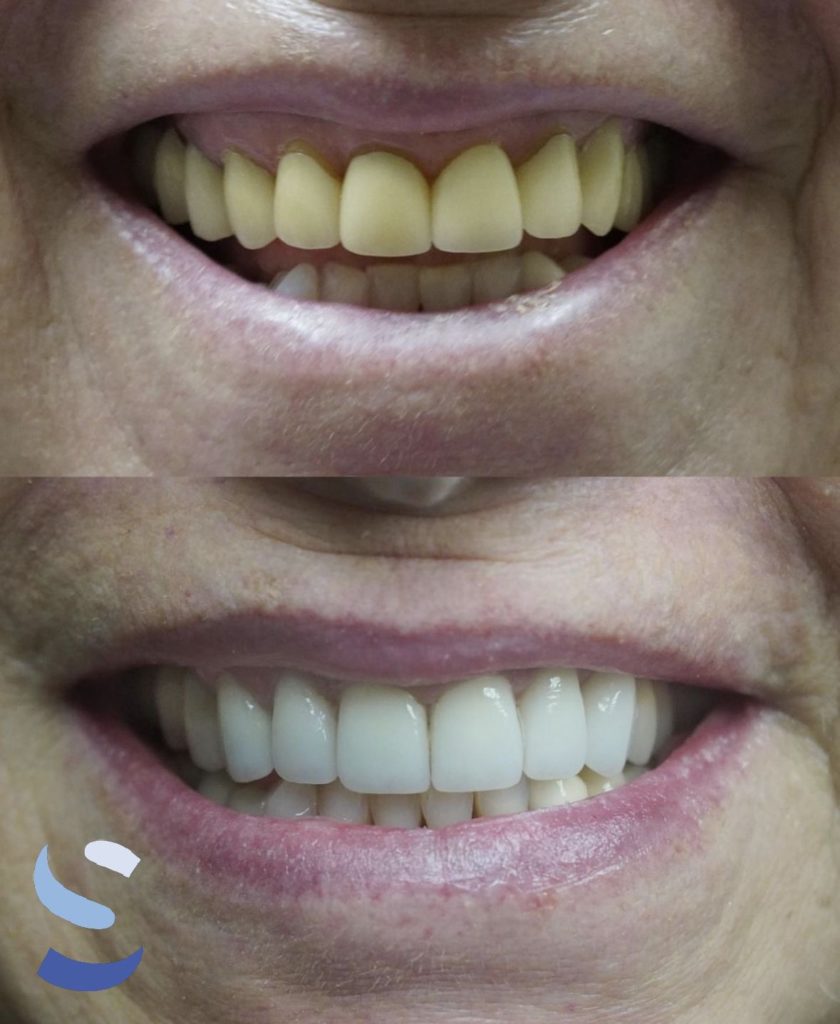 Before After Image